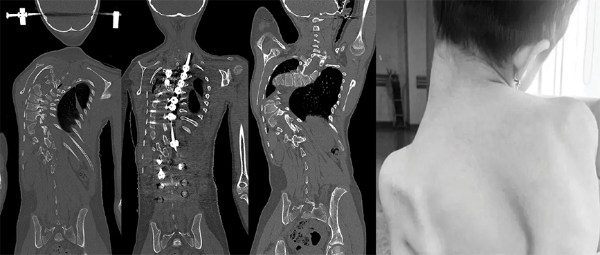 3D Printing Supports Treatment for Dorsal Scoliosis